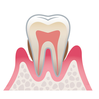 中度歯周病の状態